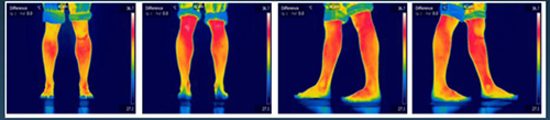 Evaluación fototérmica de extremidades inferiores