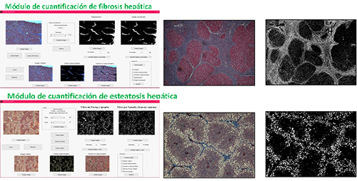 Programa HepaScan para la cuantificación de fibrosis y esteatosis hepática