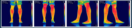 Photothermal evaluation of lower extremities