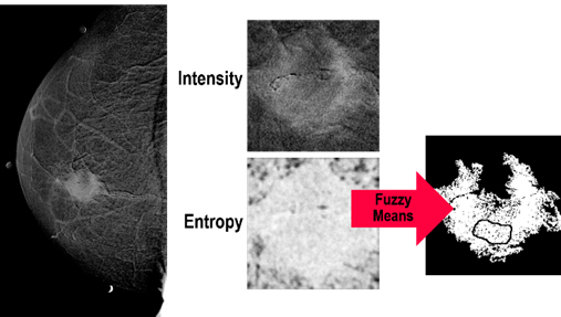 Lesion segmentation in mammographies with enhanced contrast energy subtraction, combing textural descriptors. From the master thesis of Julieta Mateos (advisor JM).