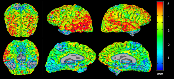 Parametrical maps of the local depth (or width) of the brain cortex, using the external Euclidean Distance Transform of the white matter, displayed on the surface of the gray matter. Master thesis of the BSc Juan Velázquez (advisor JM).