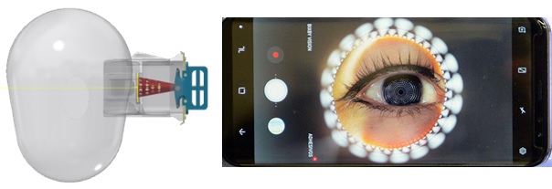 Topógrafo corneal cónico compacto basado en teléfono inteligente
